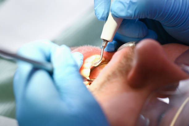 Best Emergency Tooth Extraction in Storrs, CT
